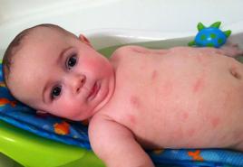 Лечение атопического дерматита у грудных детей
