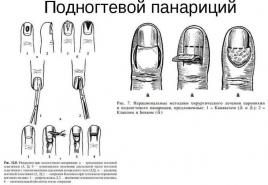 التهاب اصبع القدم