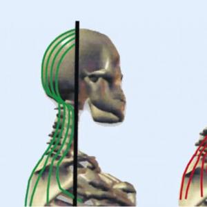 Cervical lordosis - photo, causes and treatment